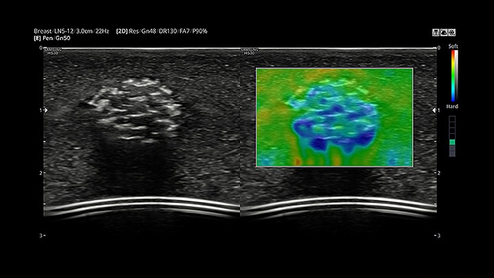 Funkcja ElastoScan™ to technologia diagnostyczna pozwalająca na obrazowanie elastyczności tkanek – wykrywa obecność zmian litych w tkankach i przekształca dane dotyczące sztywności w kodowane kolorem obrazy.