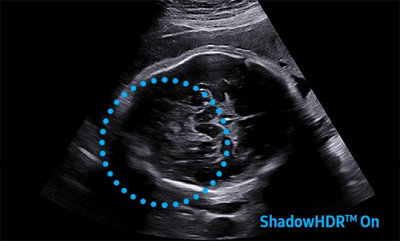 Funkcja ShadowHDR będąca częścią CrystlLive w ultrasonografach HERA W10 pozwala na skuteczne obrazowanie obszarów w cieniu akustycznym