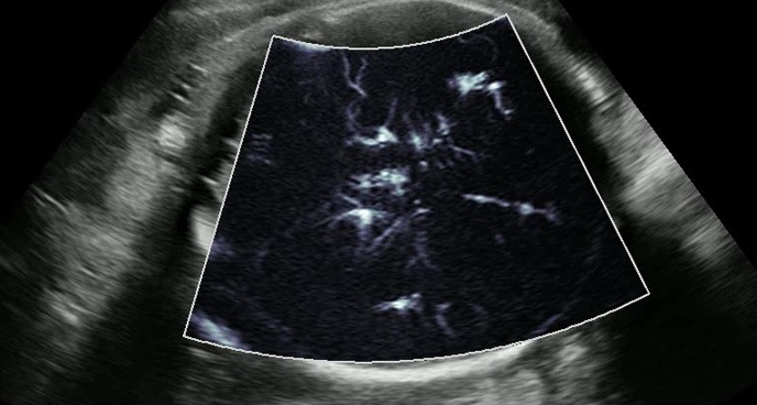 Przekrój TT przepływów w mózgu płodu - technologia MV-Flow w ultrasonografie HERA W10