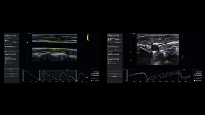Arterial Analysis™ w aparacie USG RS85 to aplikacja pozwalająca na diagnostykę naczyń we wczesnym etapie zmian, dzięki analizie jakościowej i ilościowej kurczliwości ścian tętnicy szyjnej